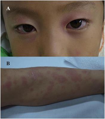 Acute Rheumatic Fever and Kawasaki Disease Occurring in a Single Patient